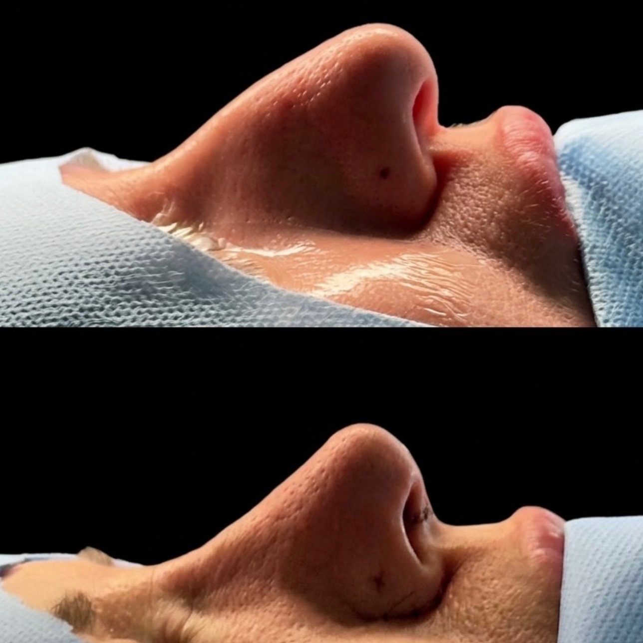 Rinoplastia — vista frontal