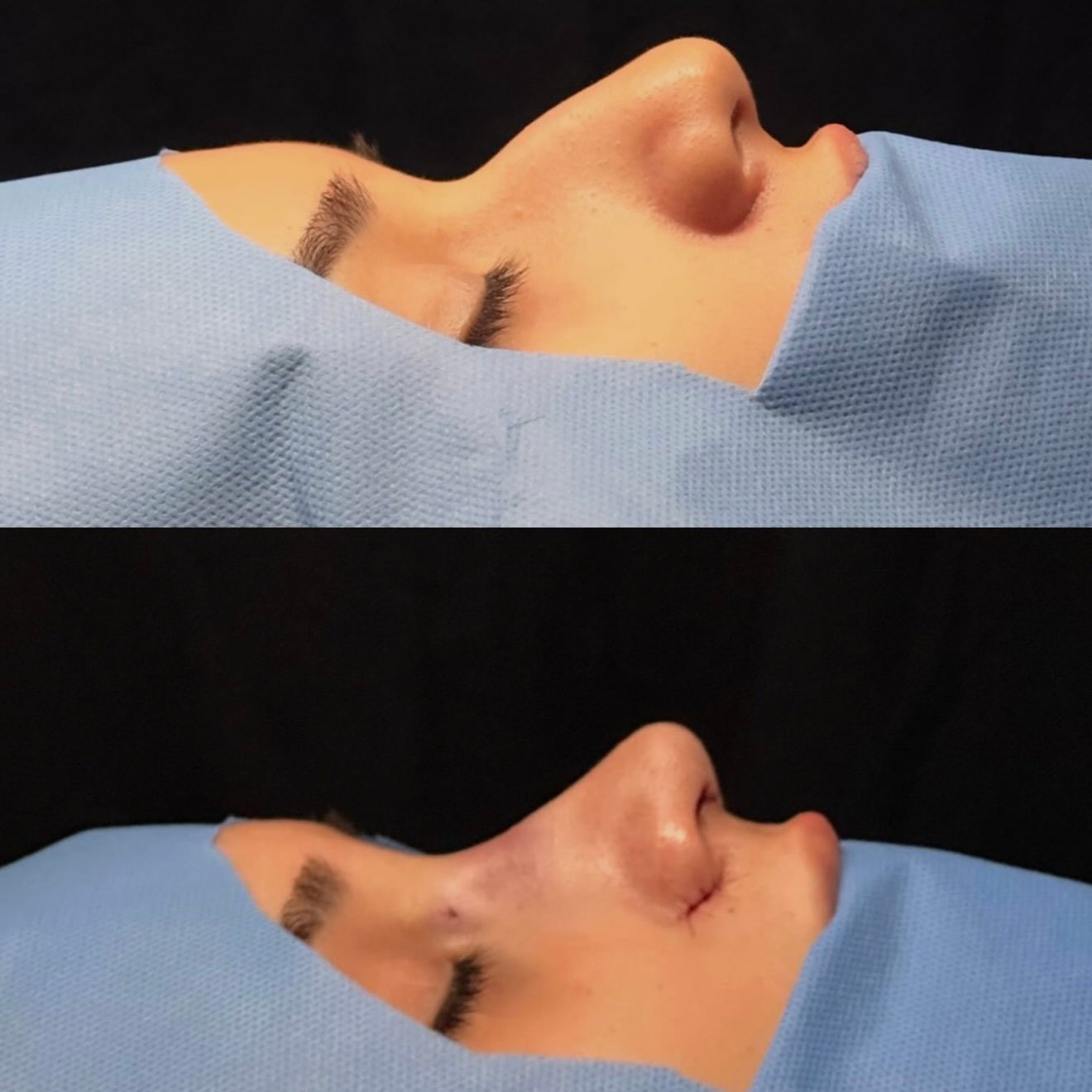 Rinoplastia — vista inferior