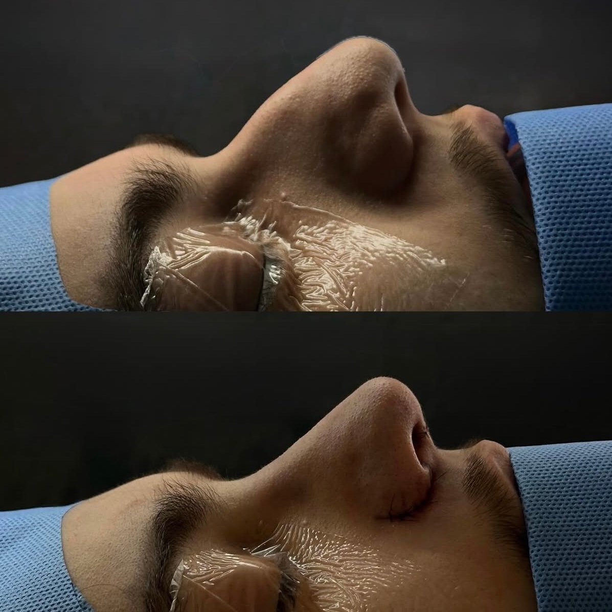 Rinoplastia — perfil