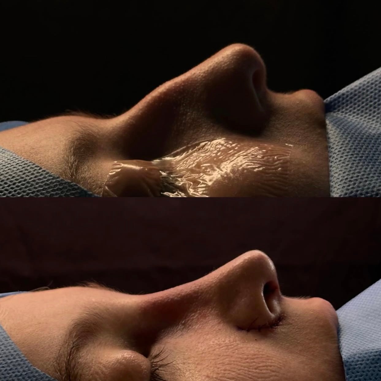Rinoplastia — perfil masculino