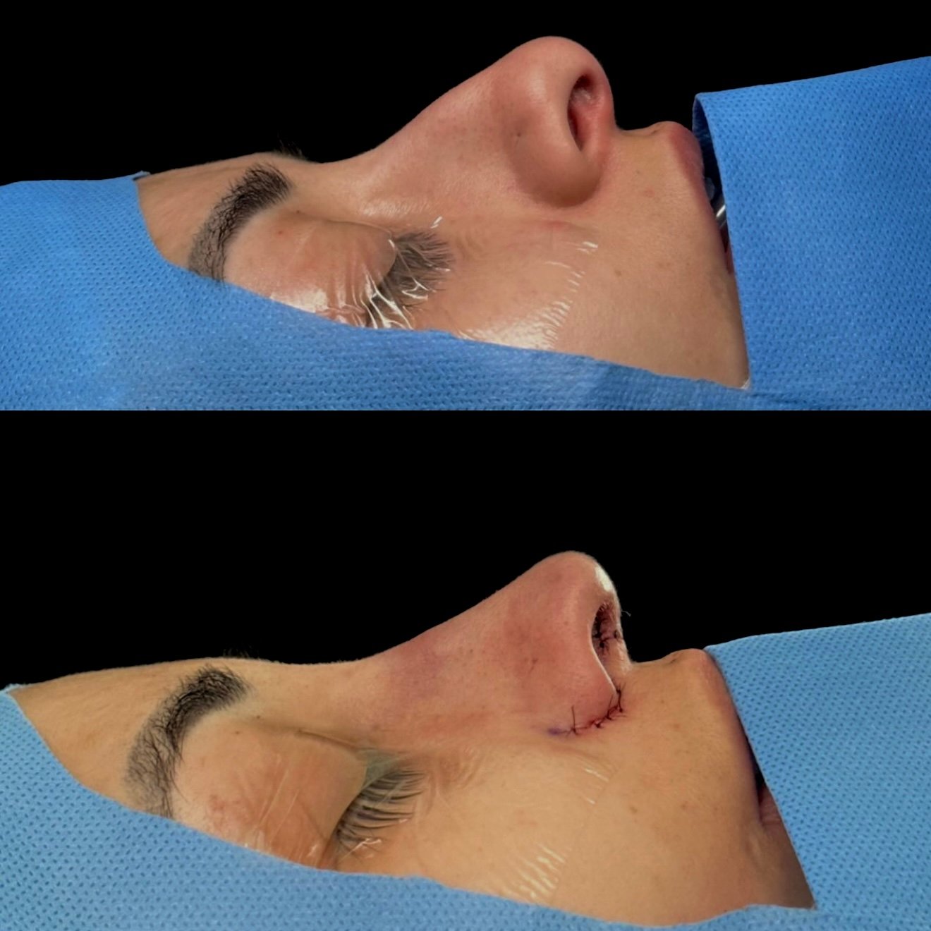 Rinoplastia — perfil feminino