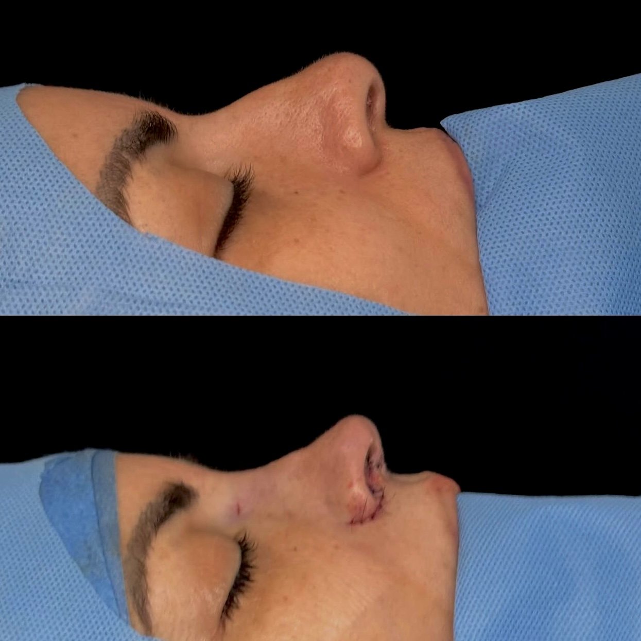 Harmonização facial